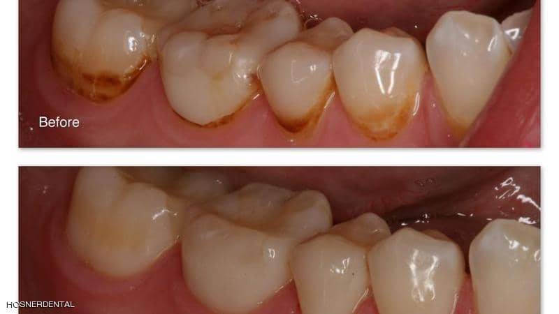 كيف يمكن التخلص من البقع البنية على الأسنان؟