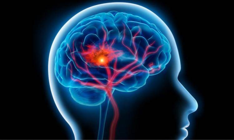 اكتشاف مناطق في الدماغ تتأثر بارتفاع ضغط الدم